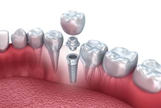 dental implants Apopka dentist